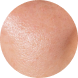 Fedtet hud