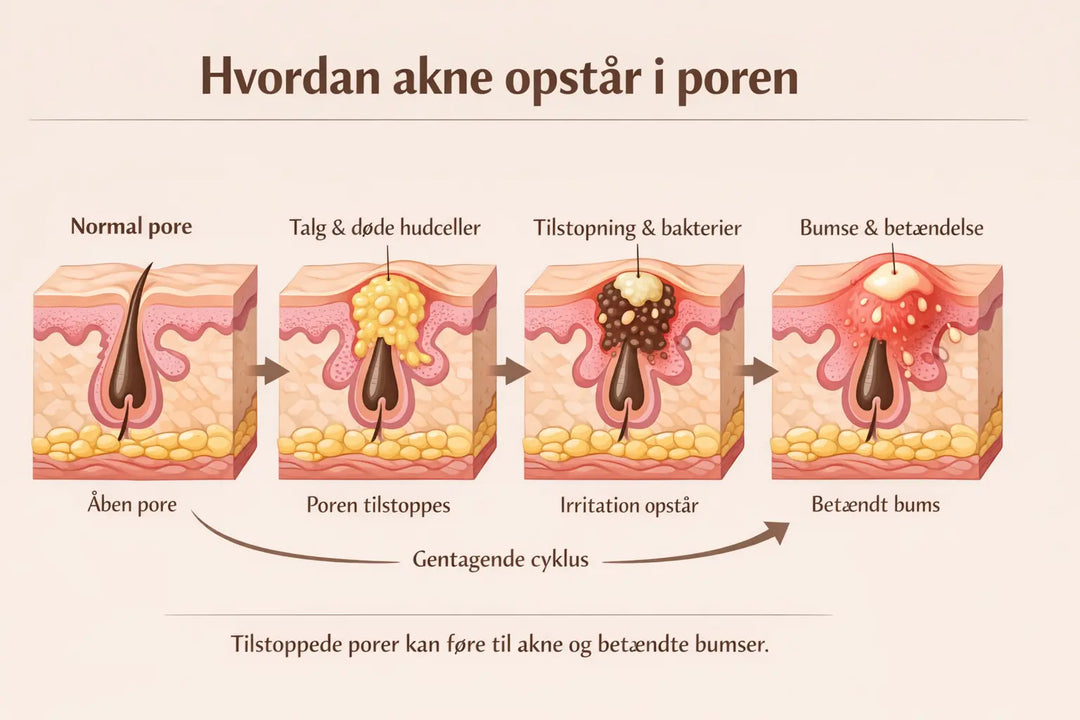 Salicylsyre mod akne