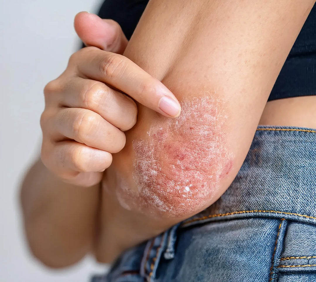 Kvinde med slem psoriasis på albuen